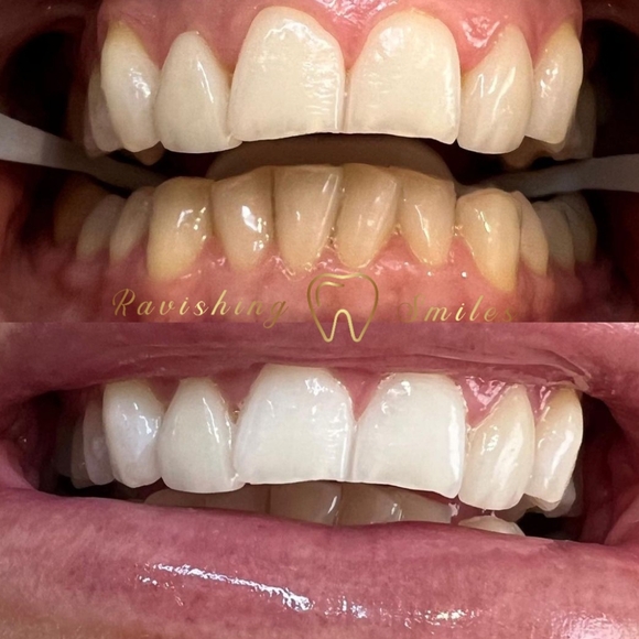 Teeth Whitening Pen. 16% Hydrogen Peroxide. No LED Accelerator Light needed. - Picture 6 of 7